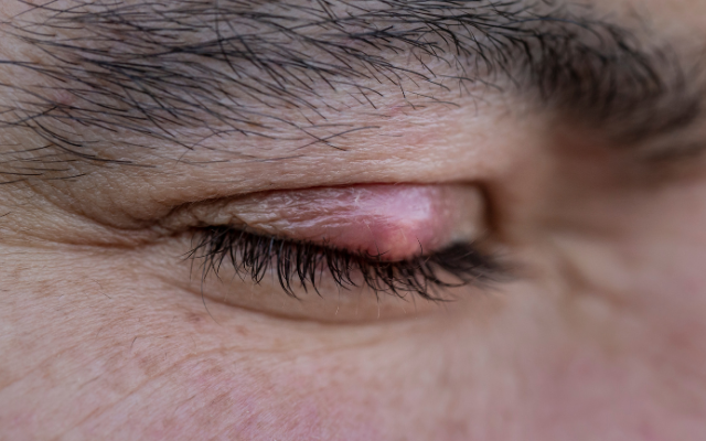 霰粒腫・麦粒腫