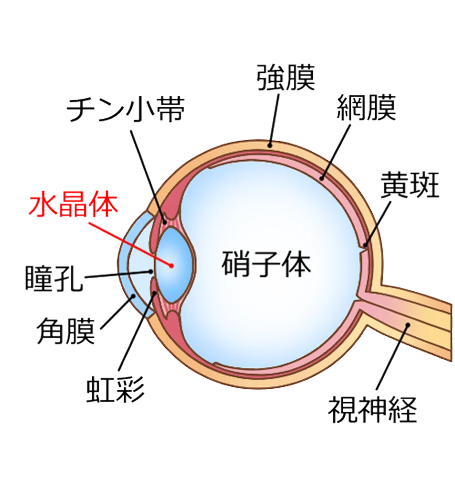 白内障のイメージ