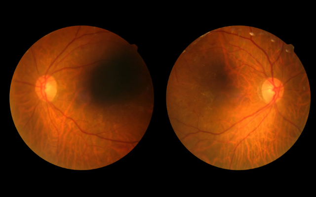 網膜硝子体疾患とは