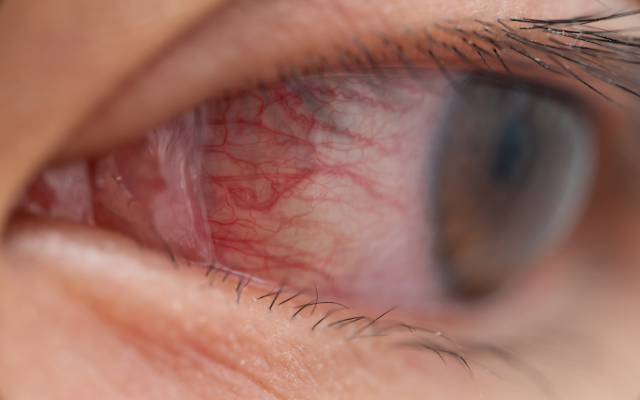 目が充血する