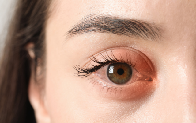 まぶたが腫れる