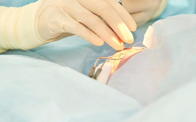 屈折異常の治療